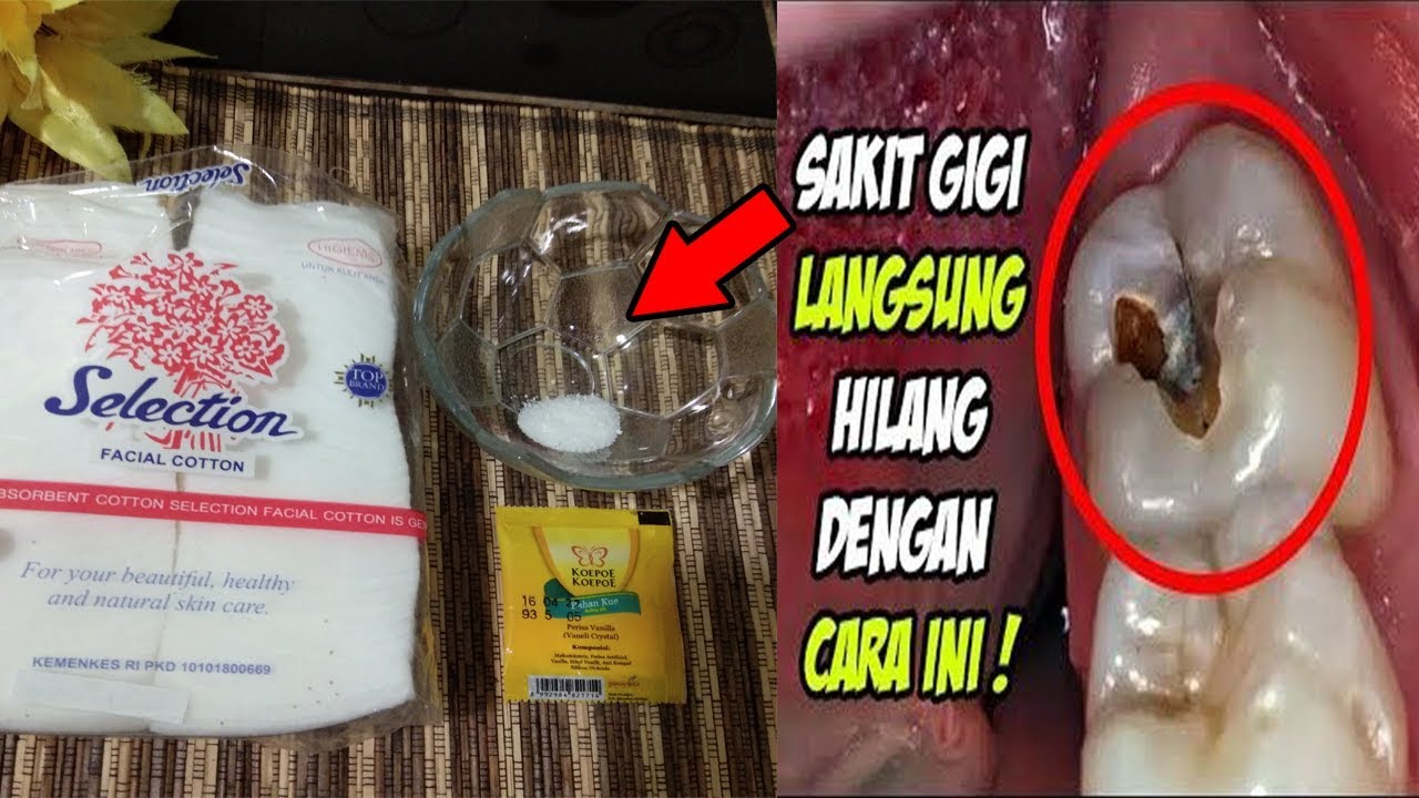 Cara mengobati sakit gigi yang kambuh secara berulang